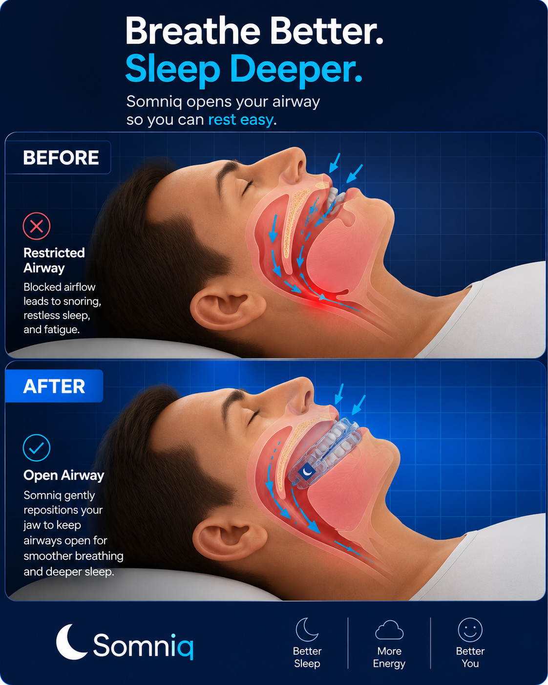 THE COMFORTABLE, NON-TOXIC ANTI-SNORE DEVICE